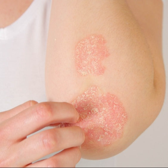 Autoimmune Rash Causes: What You Need to Know for Better Health