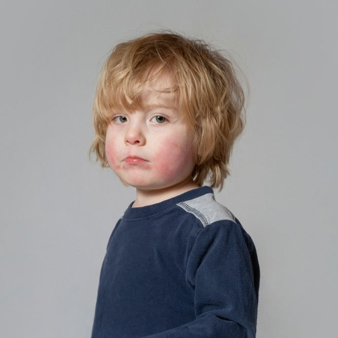 How Stress Affects Eczema and What You Can Do About It